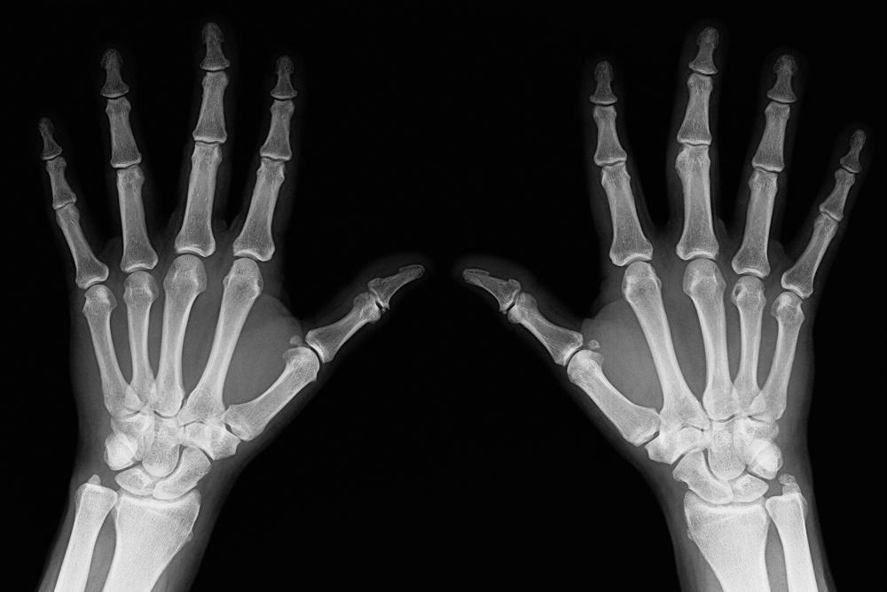 X-ray image of two hands displaying the skeletal structure and bone alignment clearly.